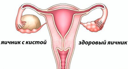 Киста правого яичника или беременность thumbnail