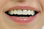 Восстановление зубов — способы реставрации