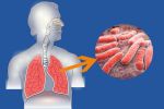 Туберкулез - смертельный недуг