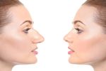 Ринопластика: правильный шаг к красивому носу